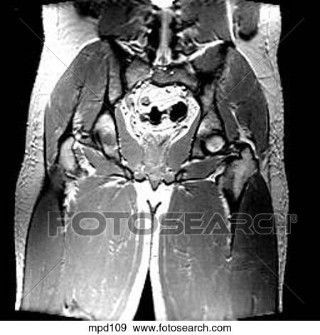 Hips/Legs - Coronal View Large Illustration Stock Illustration - Hips/Legs - Coronal. Fotosearch