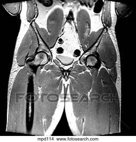 Hips/Legs - Coronal View Large Illustration Stock Illustration - Hips/Legs - Coronal. Fotosearch
