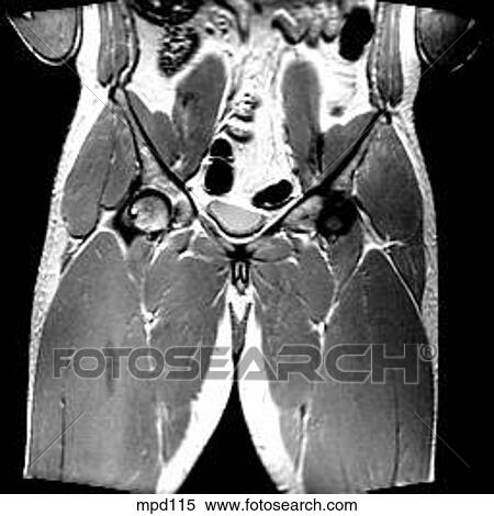 Hips/Legs - Coronal View Large Illustration Stock Illustration - Hips/Legs - Coronal. Fotosearch