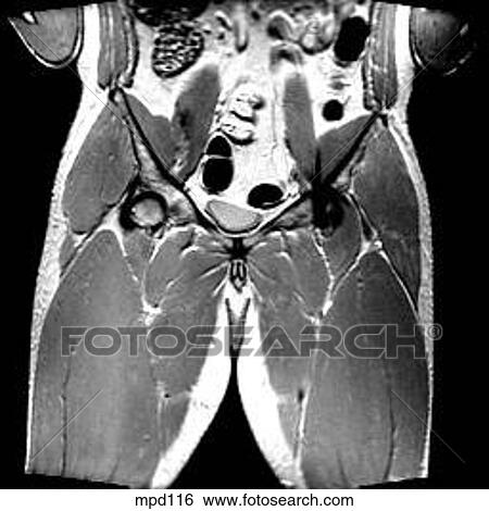 Hips/Legs - Coronal View Large Illustration Stock Illustration - Hips/Legs - Coronal. Fotosearch