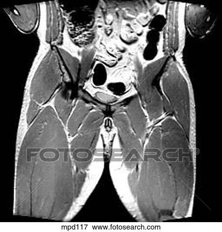 Hips/Legs - Coronal View Large Illustration Stock Illustration - Hips/Legs - Coronal. Fotosearch