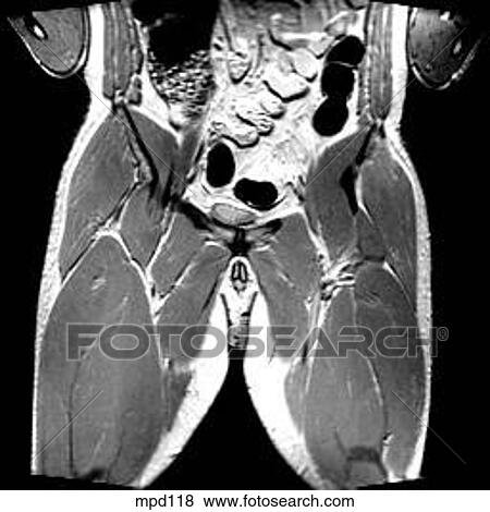 Hips/Legs - Coronal View Large Illustration Stock Illustration - Hips/Legs - Coronal. Fotosearch