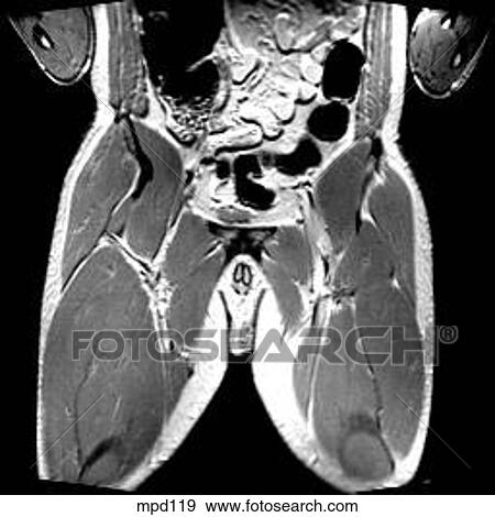 Hips/Legs - Coronal View Large Illustration Stock Illustration - Hips/Legs - Coronal. Fotosearch