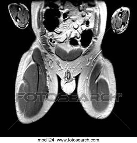 Hips/Legs - Coronal View Large Illustration Stock Illustration - Hips/Legs - Coronal. Fotosearch