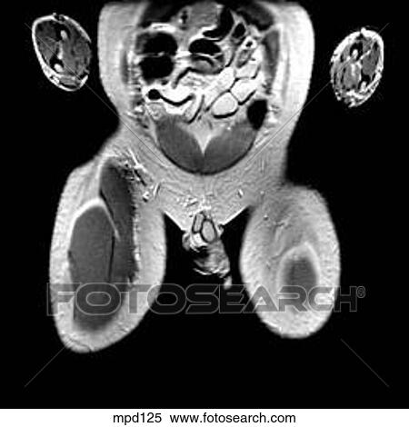 Hips/Legs - Coronal View Large Illustration Stock Illustration - Hips/Legs - Coronal. Fotosearch