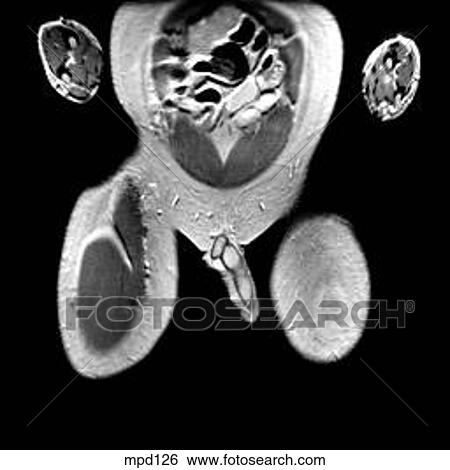 Hips/Legs - Coronal View Large Illustration Stock Illustration - Hips/Legs - Coronal. Fotosearch