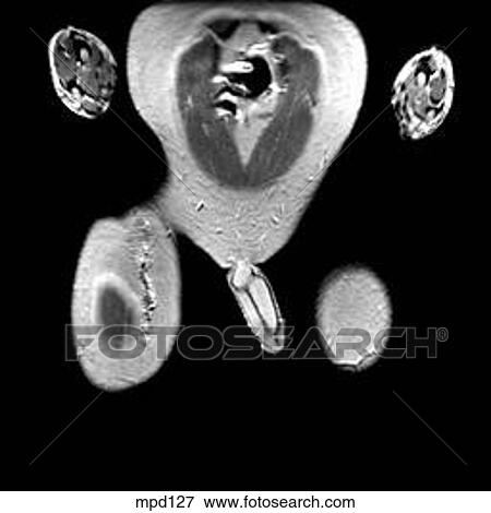 Hips/Legs - Coronal View Large Illustration Stock Illustration - Hips/Legs - Coronal. Fotosearch