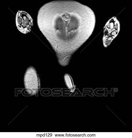 Hips/Legs - Coronal View Large Illustration Stock Illustration - Hips/Legs - Coronal. Fotosearch