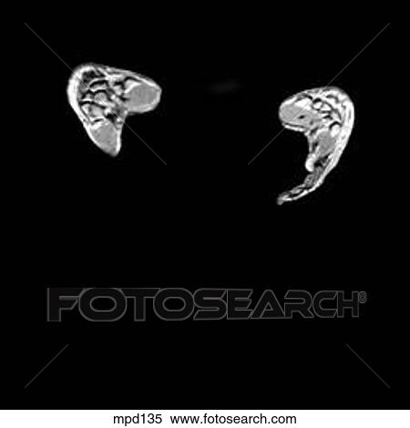 Hips/Legs - Coronal View Large Illustration Stock Illustration - Hips/Legs - Coronal. Fotosearch