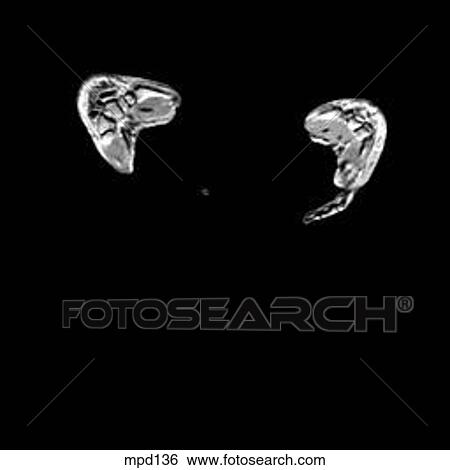 Hips/Legs - Coronal View Large Illustration Stock Illustration - Hips/Legs - Coronal. Fotosearch