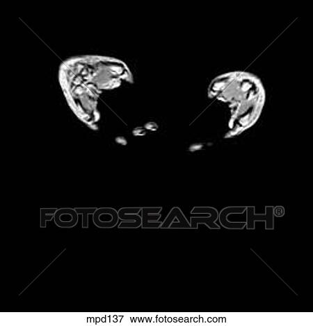 Hips/Legs - Coronal View Large Illustration Stock Illustration - Hips/Legs - Coronal. Fotosearch