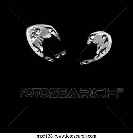 Hips/Legs - Coronal View Large Illustration Stock Illustration - Hips/Legs - Coronal. Fotosearch