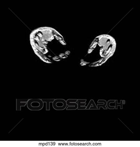 Hips/Legs - Coronal View Large Illustration Stock Illustration - Hips/Legs - Coronal. Fotosearch