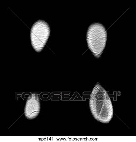 Knee - Coronal View Large Illustration Clip Art - Knee - Coronal. Fotosearch