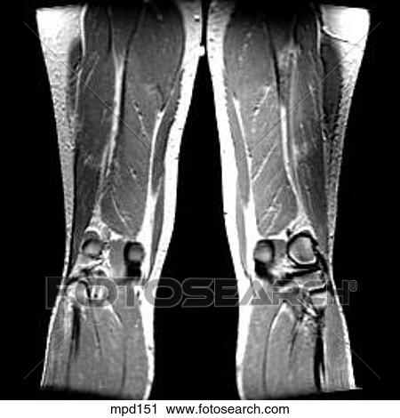 Clip Art - Knee - Coronal. Fotosearch