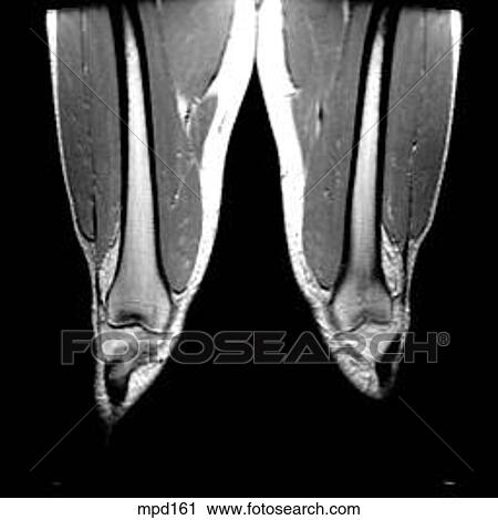 Knee - Coronal View Large Illustration Clip Art - Knee - Coronal. Fotosearch
