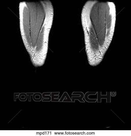 Knee - Coronal View Large Illustration Clip Art - Knee - Coronal. Fotosearch