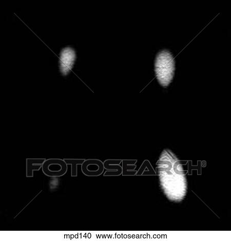 Knee - Coronal View Large Illustration Clipart - Knee - Coronal. Fotosearch