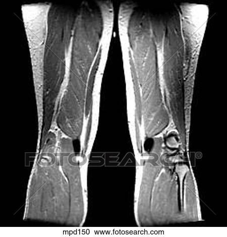 Knee - Coronal View Large Illustration Clipart - Knee - Coronal. Fotosearch