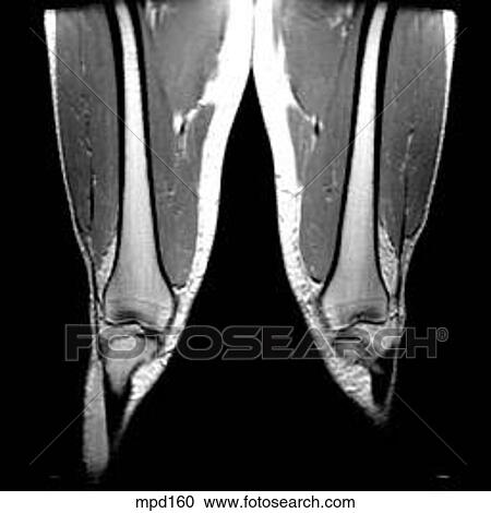 Knee - Coronal View Large Illustration Clipart - Knee - Coronal. Fotosearch