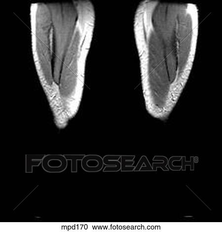Knee - Coronal View Large Illustration Clipart - Knee - Coronal. Fotosearch