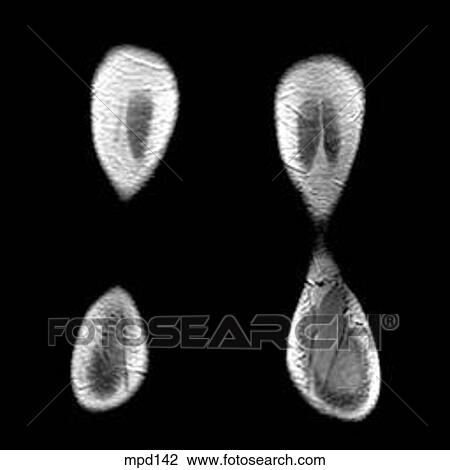 Knee - Coronal View Large Illustration Drawing - Knee - Coronal. Fotosearch