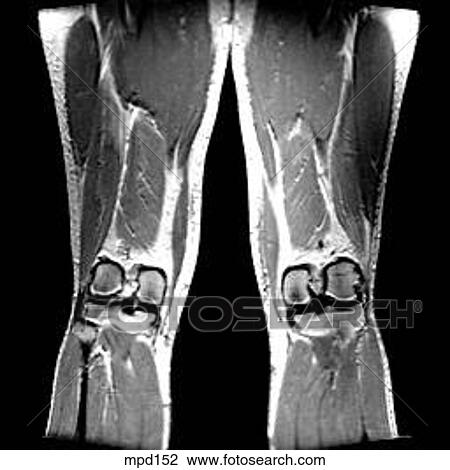 Knee - Coronal View Large Illustration Drawing - Knee - Coronal. Fotosearch