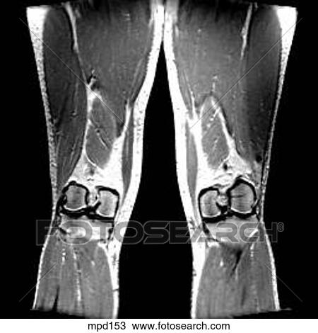 Knee - Coronal View Large Illustration Drawing - Knee - Coronal. Fotosearch