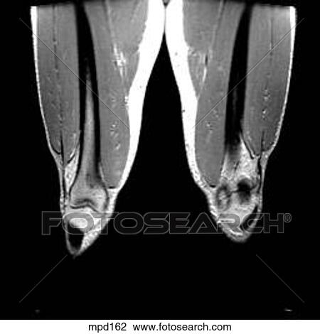 Knee - Coronal View Large Illustration Drawing - Knee - Coronal. Fotosearch