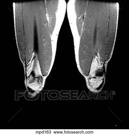 Knee - Coronal View Large Illustration Drawing - Knee - Coronal. Fotosearch