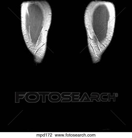 Knee - Coronal View Large Illustration Drawing - Knee - Coronal. Fotosearch