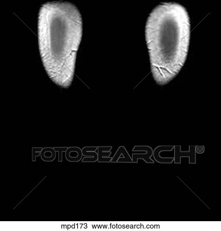 Knee - Coronal View Large Illustration Drawing - Knee - Coronal. Fotosearch