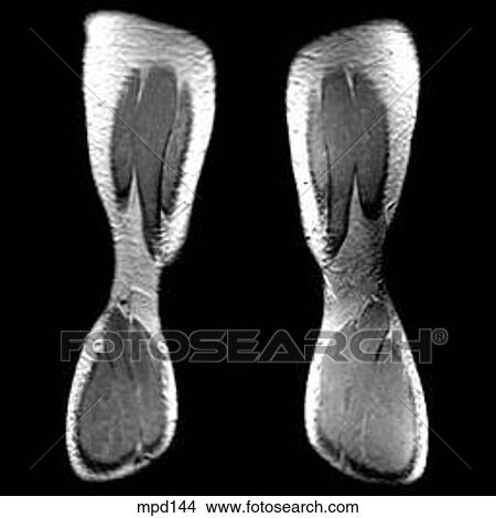 Knee - Coronal View Large Illustration Stock Illustration - Knee - Coronal. Fotosearch