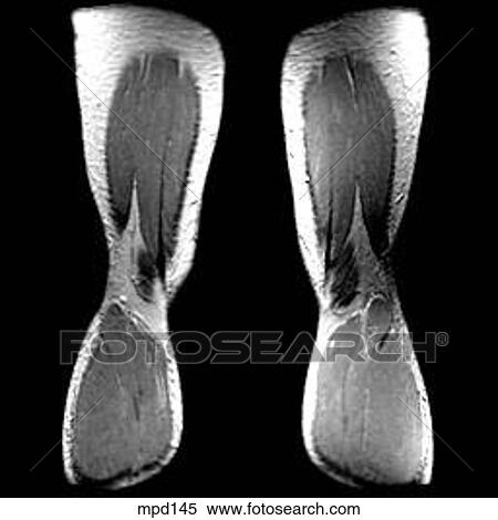 Knee - Coronal View Large Illustration Stock Illustration - Knee - Coronal. Fotosearch