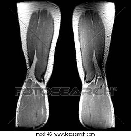 Knee - Coronal View Large Illustration Stock Illustration - Knee - Coronal. Fotosearch