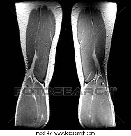 Knee - Coronal View Large Illustration Stock Illustration - Knee - Coronal. Fotosearch