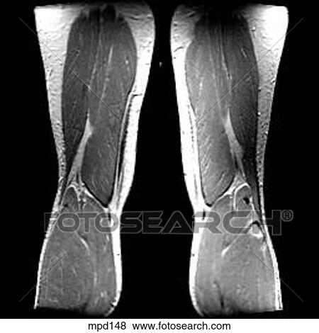 Knee - Coronal View Large Illustration Stock Illustration - Knee - Coronal. Fotosearch