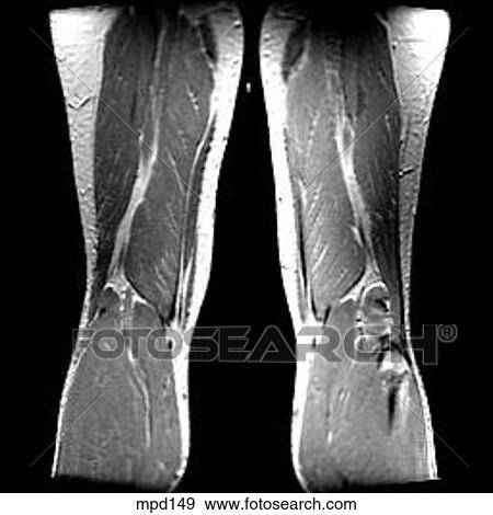 Stock Illustration - Knee - Coronal. Fotosearch