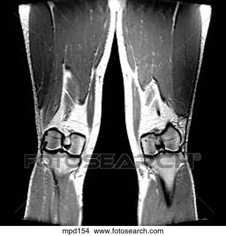 Knee - Coronal View Large Illustration Stock Illustration - Knee - Coronal. Fotosearch