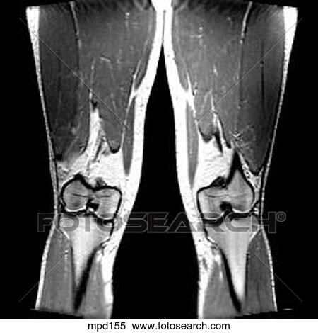 Knee - Coronal View Large Illustration Stock Illustration - Knee - Coronal. Fotosearch