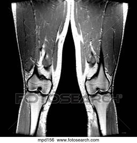 Knee - Coronal View Large Illustration Stock Illustration - Knee - Coronal. Fotosearch