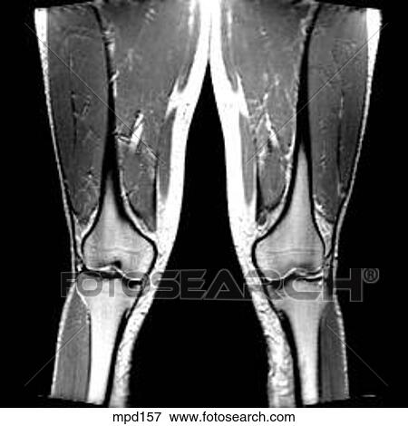 Knee - Coronal View Large Illustration Stock Illustration - Knee - Coronal. Fotosearch