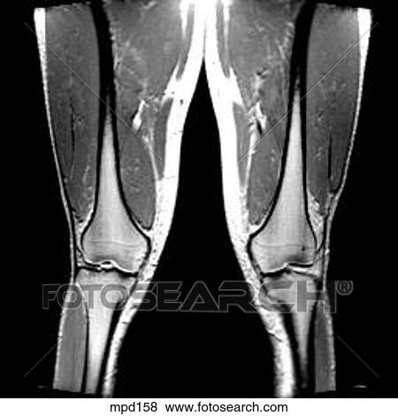 Knee - Coronal View Large Illustration Stock Illustration - Knee - Coronal. Fotosearch