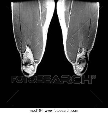 Knee - Coronal View Large Illustration Stock Illustration - Knee - Coronal. Fotosearch