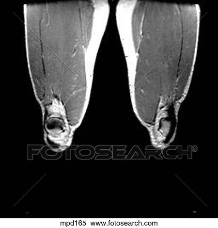 Knee - Coronal View Large Illustration Stock Illustration - Knee - Coronal. Fotosearch