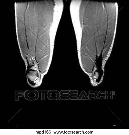 Knee - Coronal View Large Illustration Stock Illustration - Knee - Coronal. Fotosearch