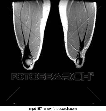 Stock Illustration - Knee - Coronal. Fotosearch