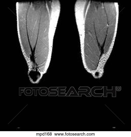 Knee - Coronal View Large Illustration Stock Illustration - Knee - Coronal. Fotosearch