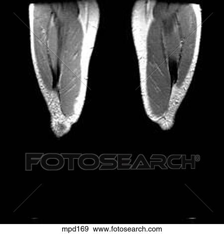 Knee - Coronal View Large Illustration Stock Illustration - Knee - Coronal. Fotosearch