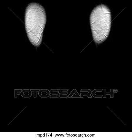 Stock Illustration - Knee - Coronal. Fotosearch
